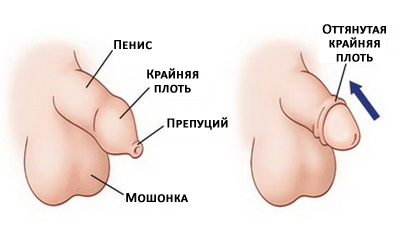 Диагностика и лечение фимоза в клинике Урологии Первого МГМУ им. И.М. Сеченова