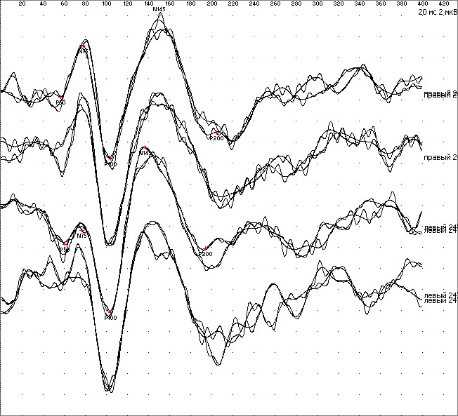 Вызванные потенциалы головного мозга