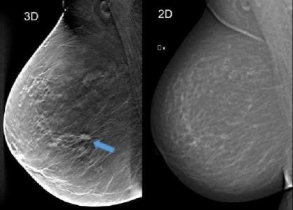 3D цифровая маммография