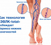 Как технология «ЭВЛК-total» побеждает Варикоз нижних конечностей